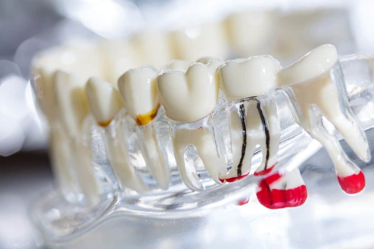 Why Root Canal Treatment Preserves Your Natural Teeth Better Than Extraction